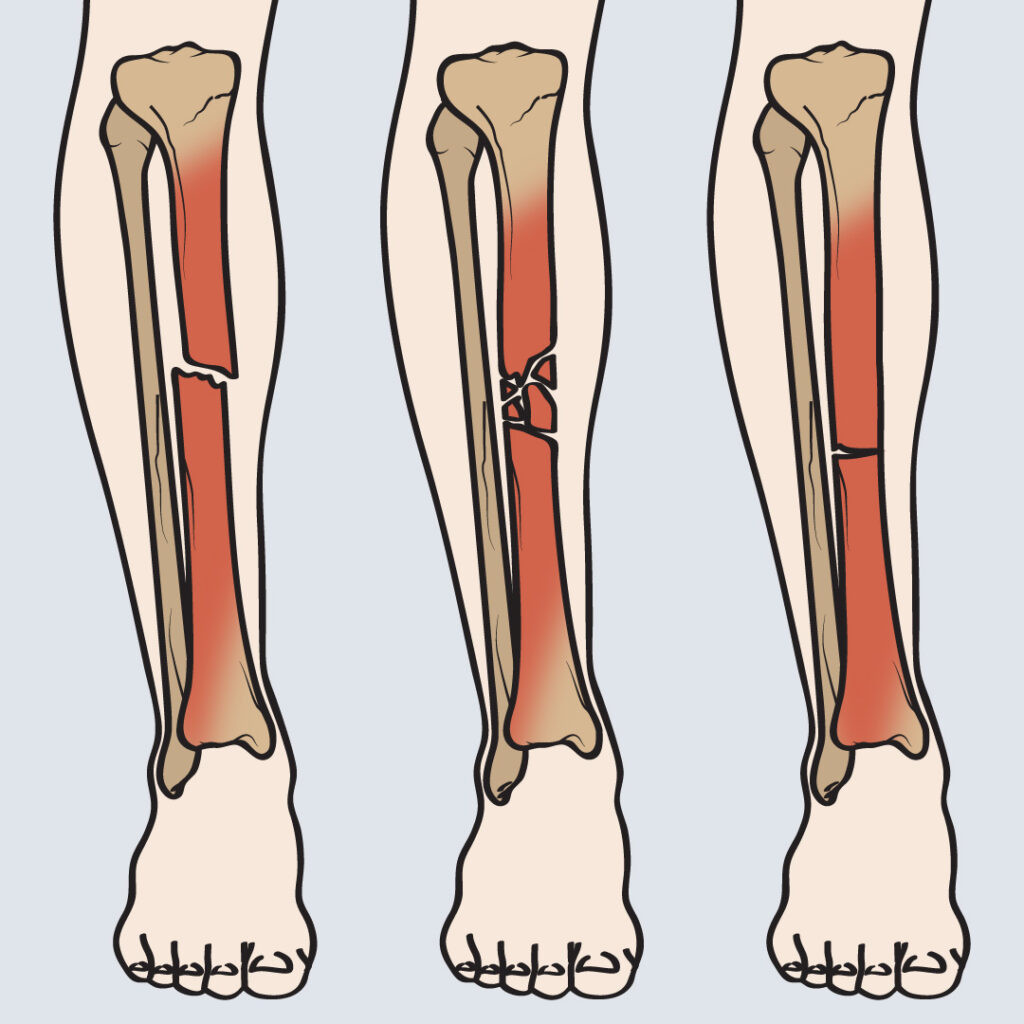 Fraktur Tibia